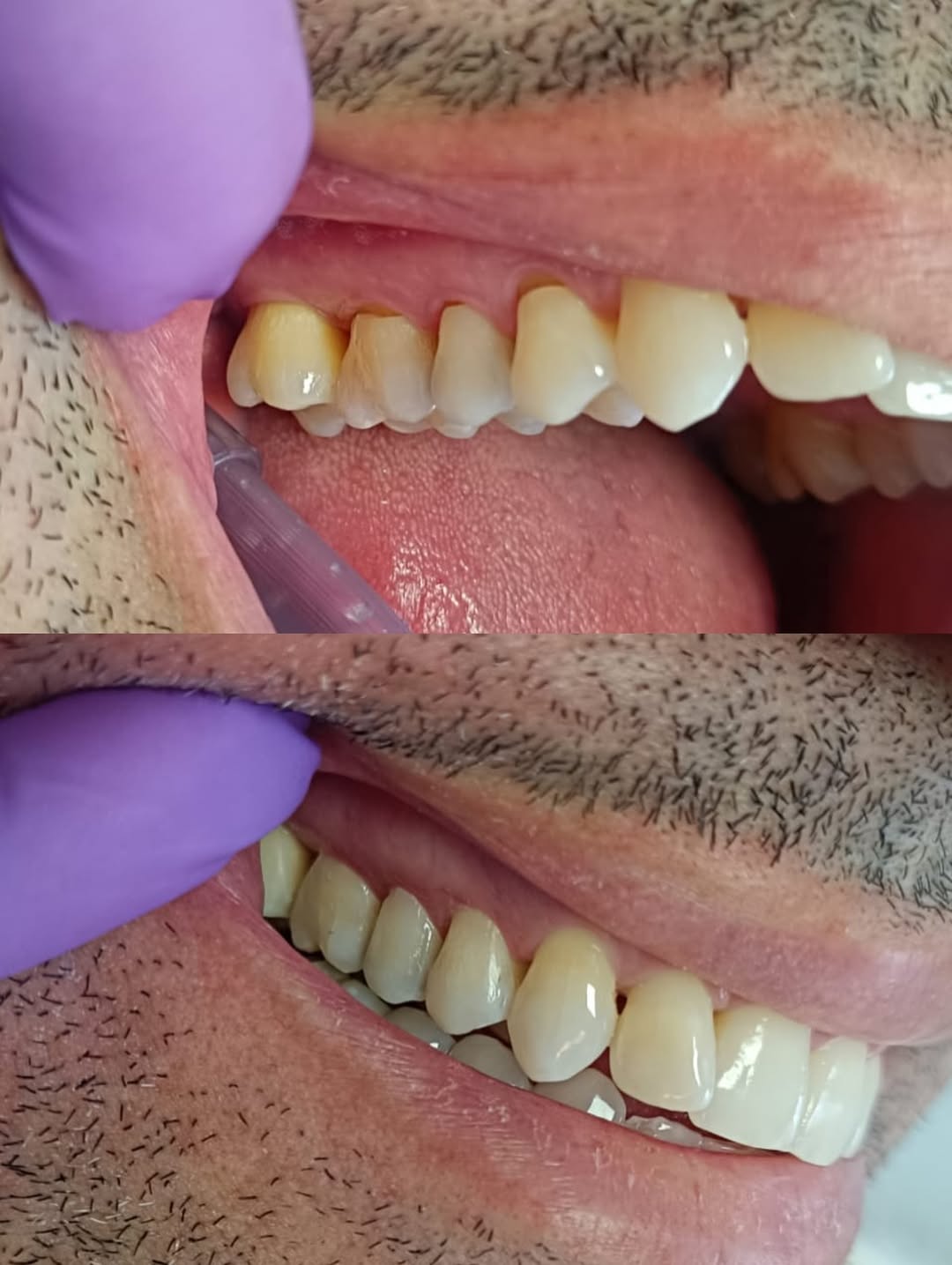 Restauração em Resina — antes e depois